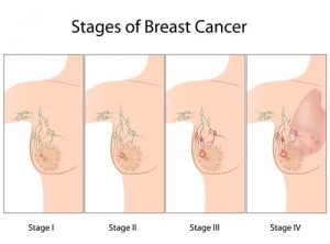 Stages-of-Breast-Cancer